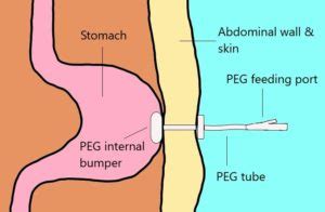 Percutaneous Endoscopic Gastrostomy (PEG) Quick Reference Guide.